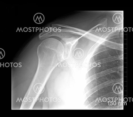 Shoulder xray 2