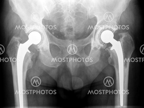 X-ray of hip