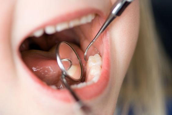 Child Dental Check-Up