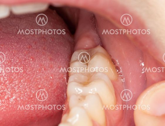 Macro image of filled teeth