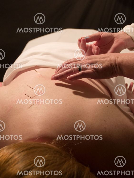 Acupuncture