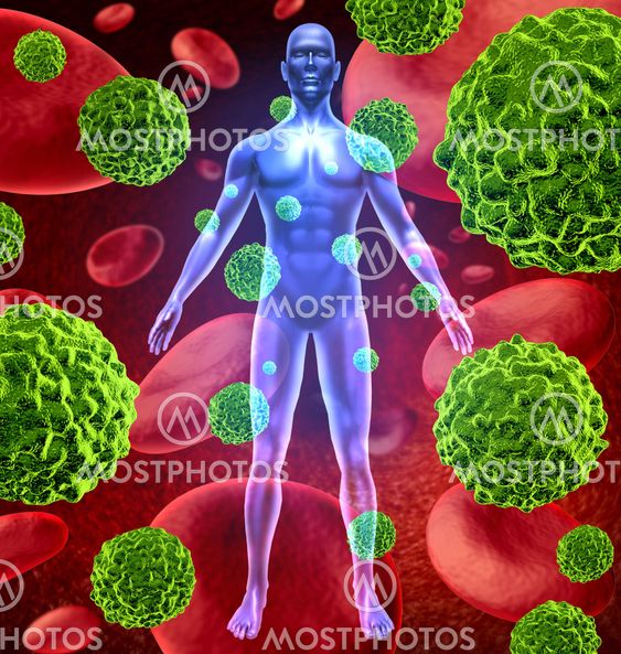 Human body with cancer cells spreading and growing