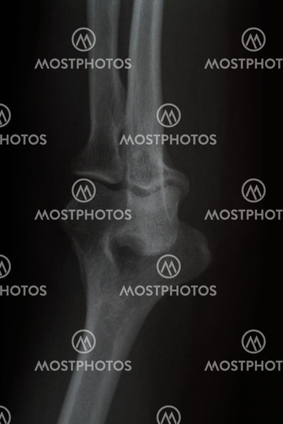X ray picture of Elbow
