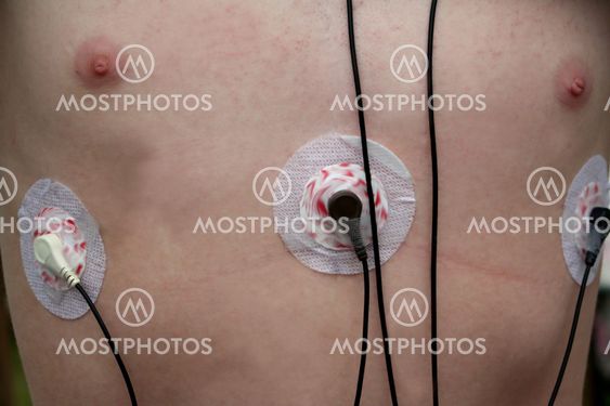 Heart Monitor Leads on Chest
