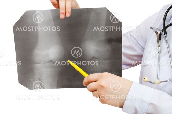 nurse points X-ray picture with human knee joint