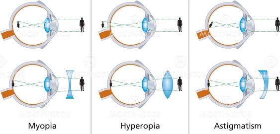 hiperopie miopia astigmatism