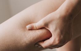 cellulite on the skin