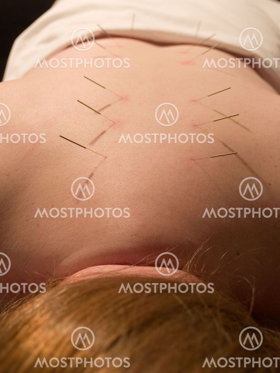 Acupuncture