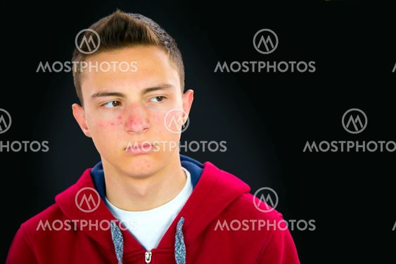 Portrait of teenage boy with acne