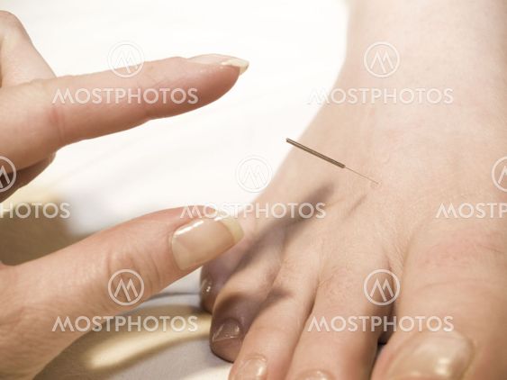 Acupuncture of the foot
