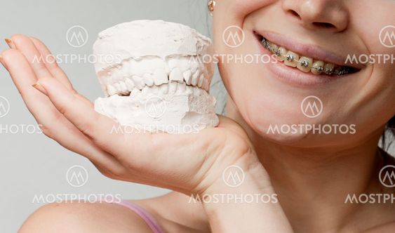 Smile with bracket and plaster jaw model