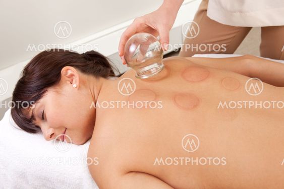 Red Fire Cupping Marks