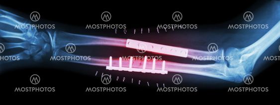 Fracture both bone of forearm ( ulnar and radius ) . It was operated and internal fixed by plate and screw