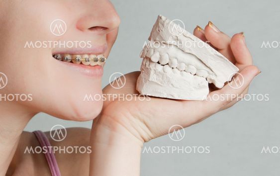 Smile with bracket and plaster jaw model