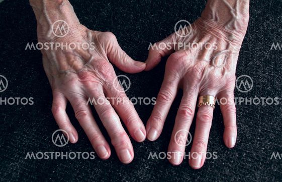 Reumatisk arthrit i händer och fingrar. Bild kvinna som lidit av diagnosen i mer än fyrtio år. Vissa leder stelopererade.