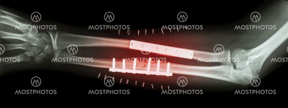 Fracture both bone of forearm ( ulnar and radius ) . It was operated and internal fixed by plate and screw