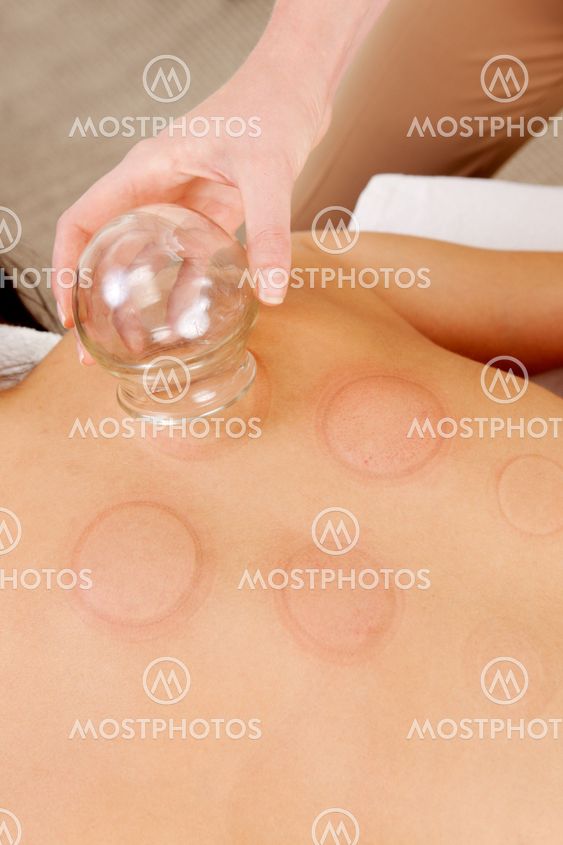 Red Fire Cupping Marks