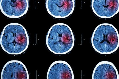 CT scan of brain with red area ( Imaging for hemorrhagic...