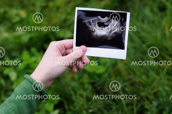 Ultrasound photographs of pregnancy