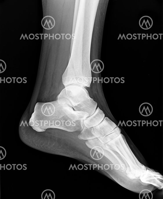 Left foot MRI with toes - X-ray