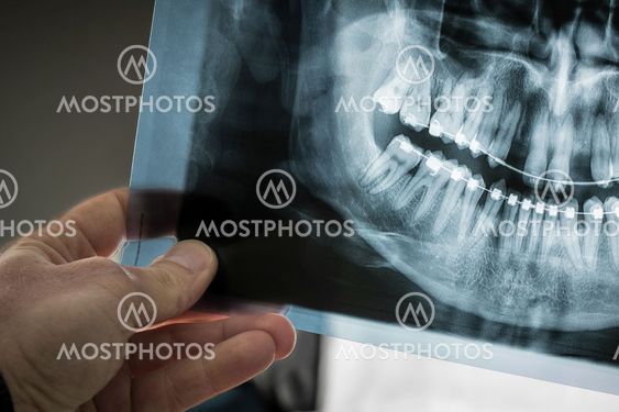 Hand holding an x-ray dental scan