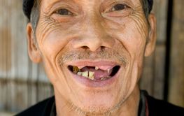 Men with bad teeth