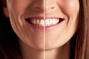 Dental procedure transforms smiling woman's teeth from...