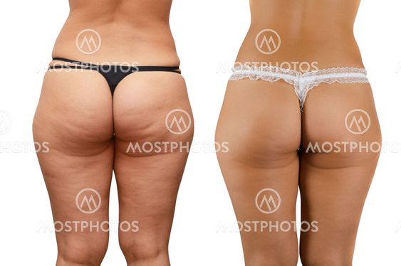 cellulite buttocks