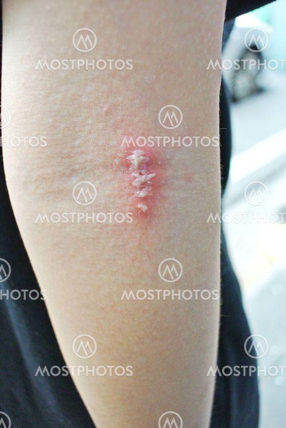 Inflammatory Purulent Derma By Boo Dogz Mostphotos