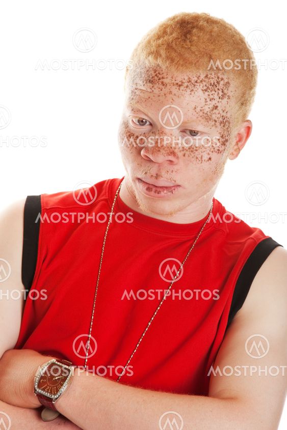 Albino Man